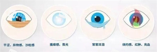 近視手術(shù)后干眼癥的癥狀2