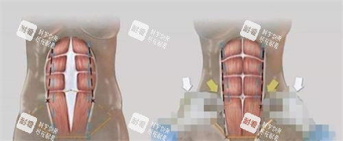 美人魚腹壁成形術(shù)的過程