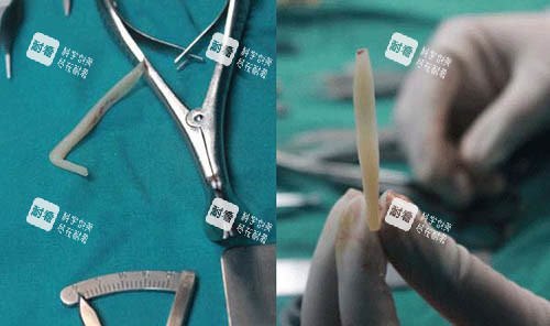 假體雕刻細節(jié)圖