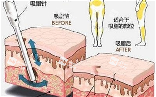 吸脂前后脂肪數(shù)量變化對(duì)比