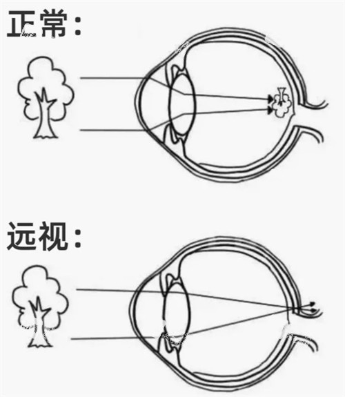正常眼鏡和遠視眼睛