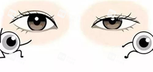 先天小瞼裂綜合征和正常眼睛的對比