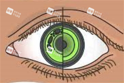 佩戴角膜塑形鏡眼睛示意圖