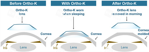 OK鏡改善眼睛角膜的弧度