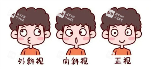 外斜內(nèi)斜和正常眼睛的對(duì)比圖