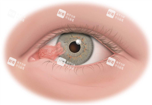 翼狀胬肉眼睛