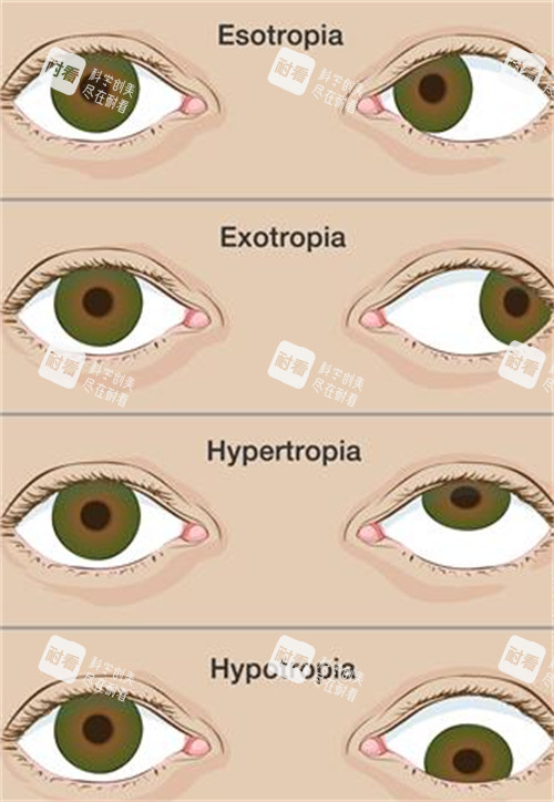 不同程度的斜視眼睛