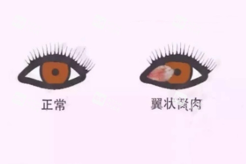 翼狀胬肉與正常眼睛對(duì)比