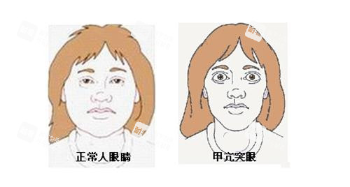 正常眼睛和突眼的對(duì)比