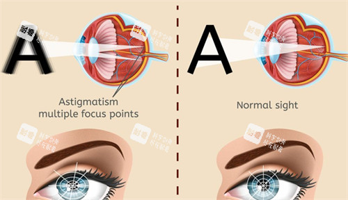 眼球震顫與正常眼睛視物的區(qū)別