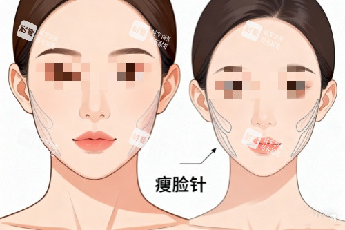 針劑注射瘦臉對(duì)比圖