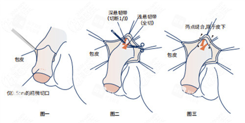 陰莖增長手術詳細步驟演示動畫圖