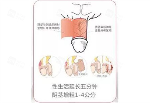 陰莖生物補片手術結果