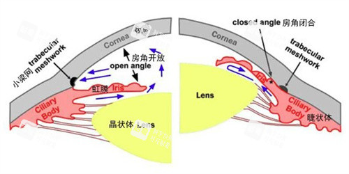 青光眼和正常眼睛的對(duì)比
