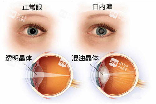 白內(nèi)障與正常眼睛對(duì)比圖