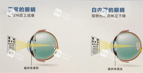 白內障的眼睛示意圖