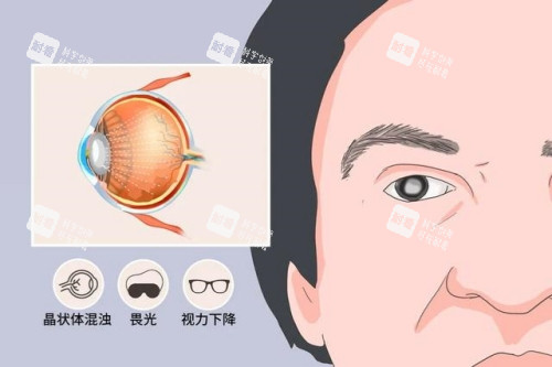 白內障癥狀卡通圖