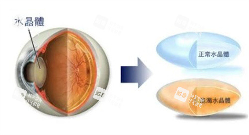 白內障的水晶體