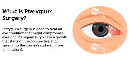 什么是眼睛翼狀胬肉