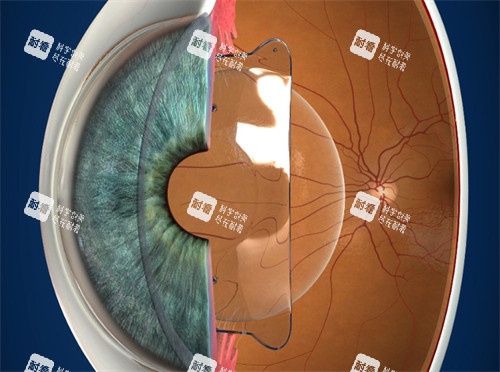 進(jìn)行晶體植入的眼睛