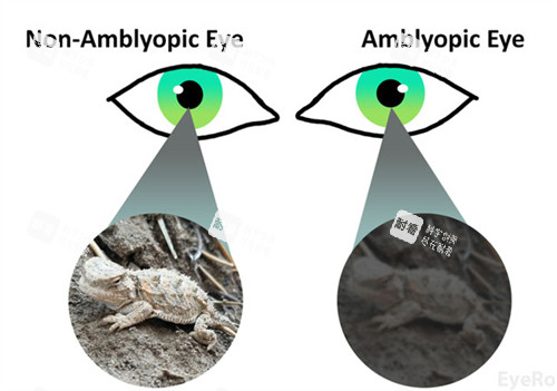 弱視和正常眼睛看物體不同