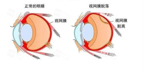 視網(wǎng)膜脫落的眼睛和正常眼睛的對(duì)比
