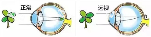 正常眼睛成像和遠(yuǎn)視眼睛成像