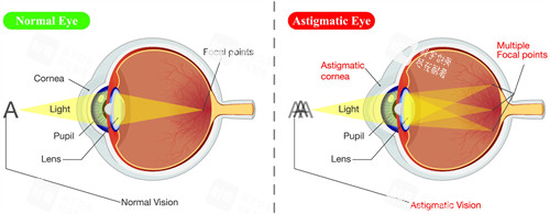 散光眼睛看不清楚東西的原理