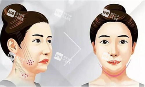 歐薇拉埋線提升是什么檔次？國產(chǎn)中高端蛋白線品牌測評，對比恒生、快翎性價比更高！