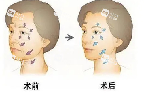 面部抗衰前后對(duì)比卡通示意圖