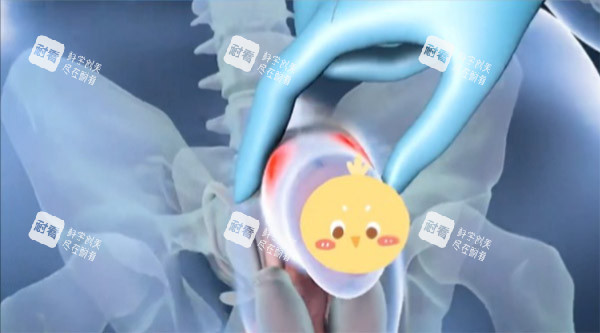 增大增粗手術(shù)照片