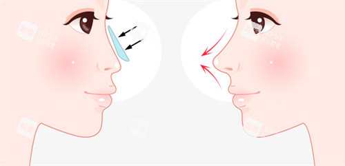 假體隆鼻前后對比
