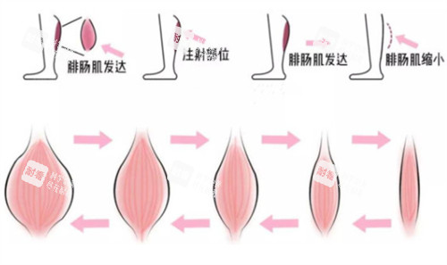 瘦腿注射前后對比