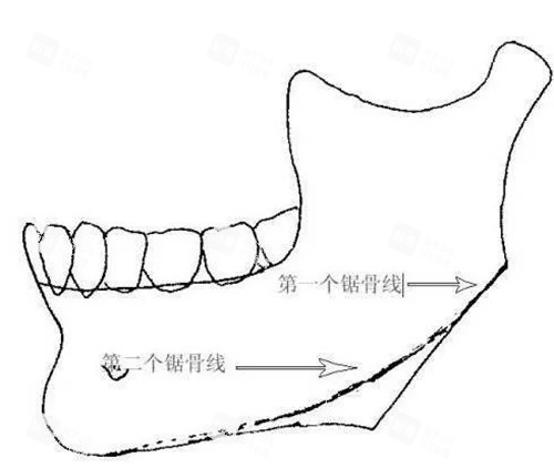 下頜骨截骨出現(xiàn)二次角示意圖
