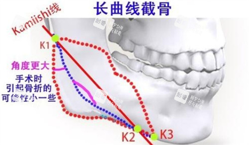 下頜角長曲線截骨的截骨位置