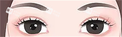 雙眼皮術(shù)后示意圖