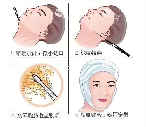 面部吸脂步驟動(dòng)畫演示圖