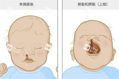 兔唇單側(cè)唇裂
