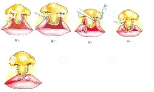 唇裂鼻修復(fù)圖