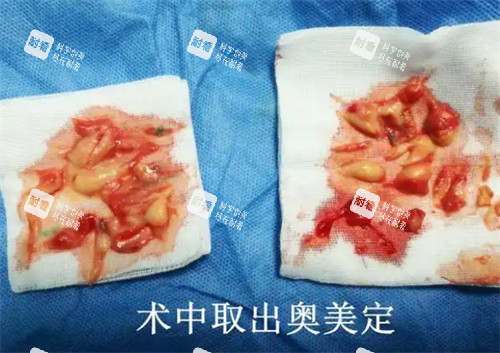 術中取出的奧美定