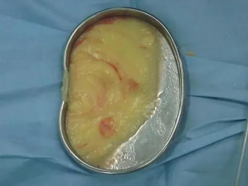 取出的奧美定實拍示意圖