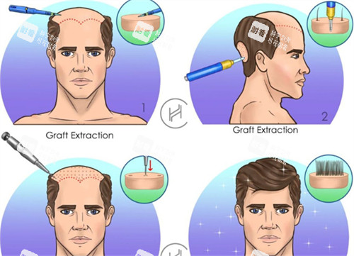 脂溢性脫發(fā)植發(fā)前后對(duì)比圖