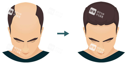 植發(fā)前后對(duì)比圖