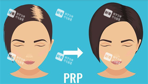 發(fā)縫加密植發(fā)前后對(duì)比圖