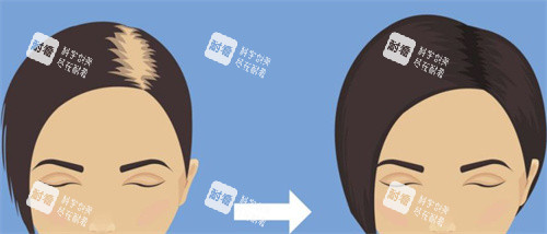 植發(fā)前后對(duì)比示圖