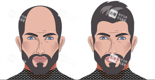 植發(fā)前后對(duì)比圖一覽