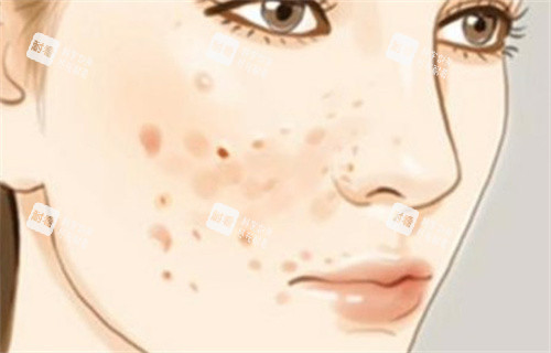 痘痘痘印