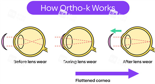 什么是角膜塑形鏡