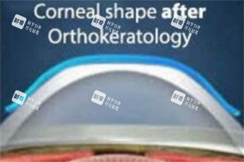 戴角膜塑形鏡后角膜形狀