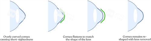 角膜塑形鏡改善眼角弧度流程圖